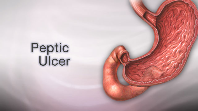 Peptic Ulcer Disease